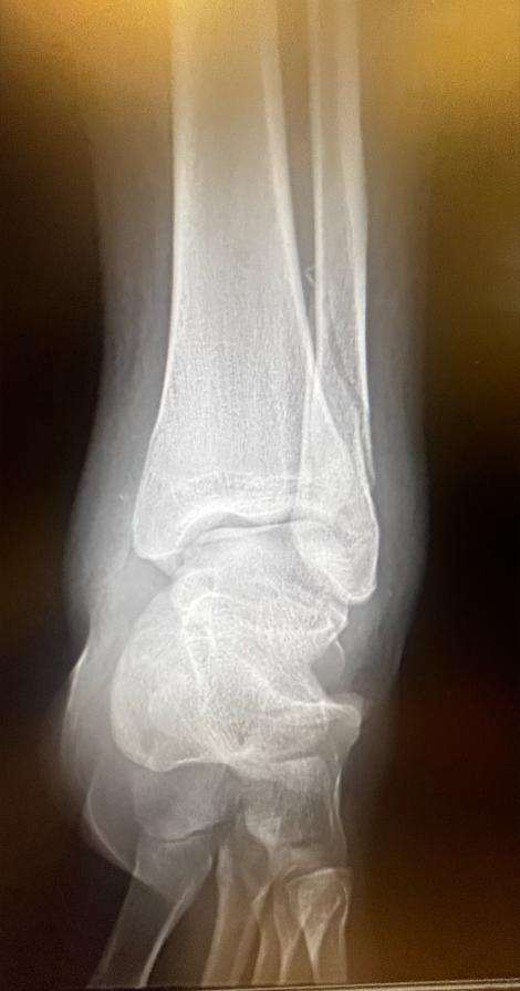 The x-ray shows the left ankle with a closed fibular fracture. Showcasing the break in the fibula, the thinner lower leg bone.